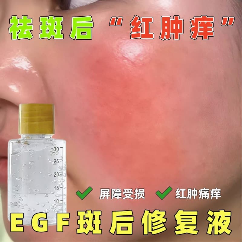 Epidermal Repair Solution Thickens Stratum Corneum, Thickens Skin, Removes Spots, Reduces Facial Redness and Swelling, Relieves Facial Pain and Itching, Hormone-Induced Facial Redness Reduction and Repair Solution