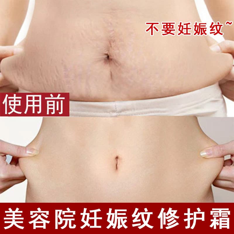 Stretch Mark Repair Cream, Remove Growth Marks and Obesity Lines, Fade Mark Oil, Repair Cream, Stretch Mark Firming Oil, Special for Pregnant Women