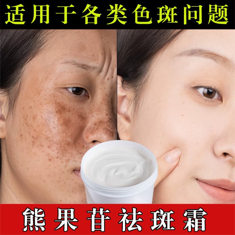 Arbutin Spot Removal Cream - Freckle and Melasma Dark Spot Corrector, Brightening Moisturizer, Salon-Grade Whitening Cream