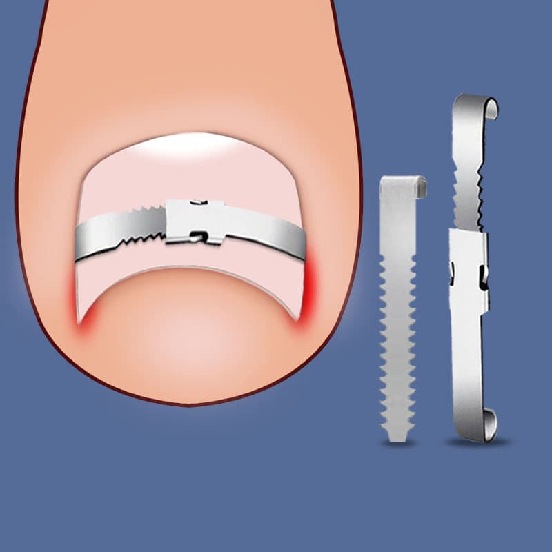 Cross-border Nail Correction Clip Ingrown Nail Corrector Nail Patch Curved Nail Puller Nail Wire Ingrown Nail In Stock