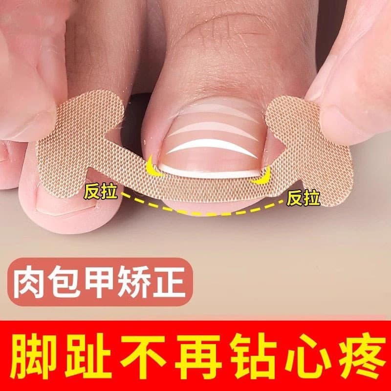 I-Shaped Toenail Patch for Ingrown Toenail, Curved Toenail Correction, Quick Repair for Deformed Toenails, Embedded Toe Corrector