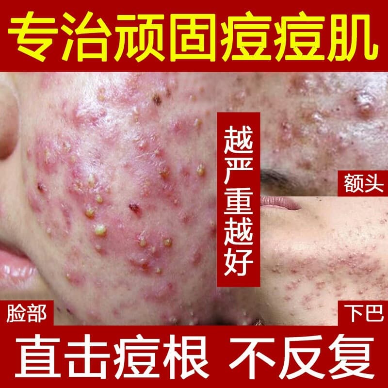 Hospital herbal anti-acne cream fades acne marks, acne scars, pimples, blackheads and improves closed skin, concave marks and acne pits
