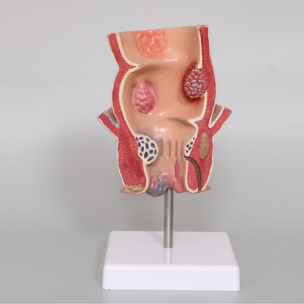 High-Quality Human Anatomy Model - Intestinal Specimen Hemorrhoid Anal Lesion Medical Teaching Aid, Rectal Pathology Model