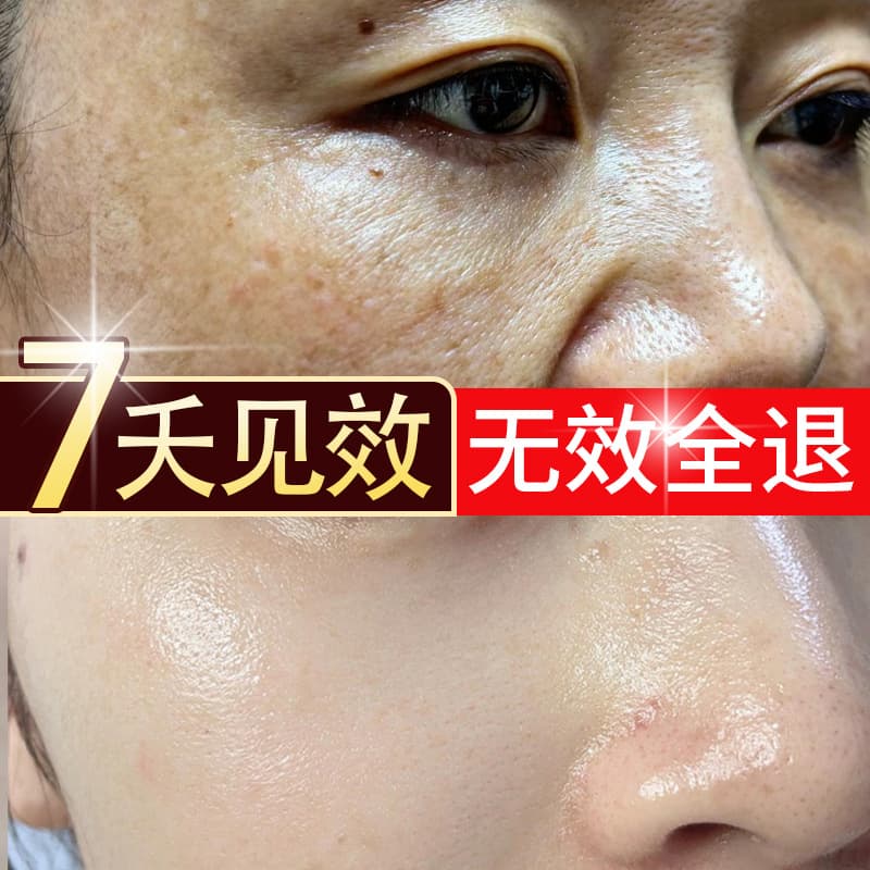 Freckle Removal Cream, Whitening and Melanin Removal, Targets Age Spots, Melasma, Sun Spots, Spot Fading, Salon-Exclusive Spot Removal Cream