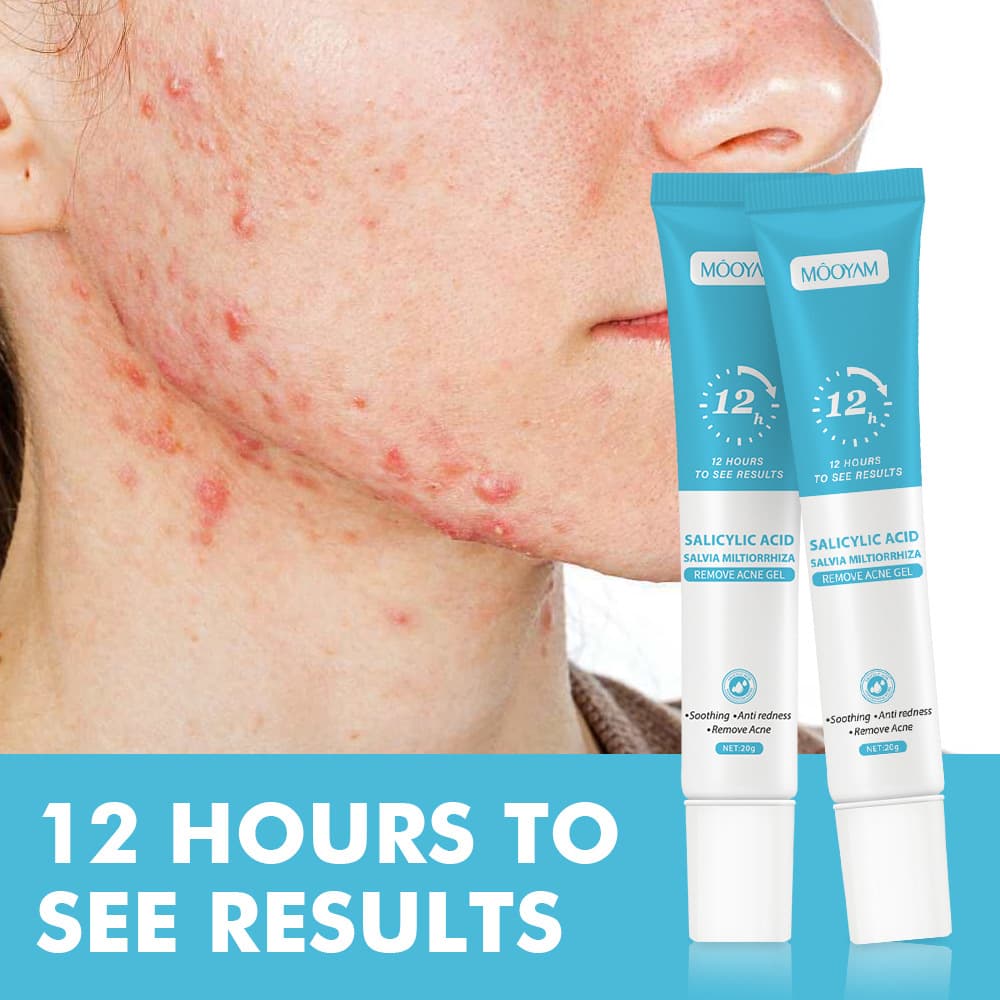 Cross-border salicylic acid acne cream fades acne scars, removes blackheads and closed comedones, shrinks pores, and plant essence acne gel.