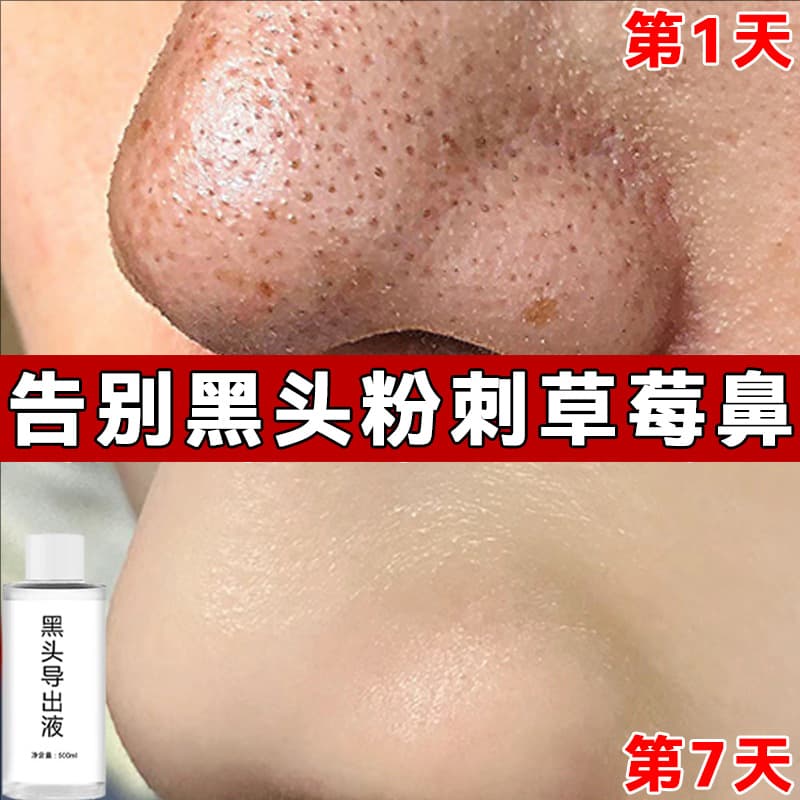 Beauty salon specializes in blackhead exporting liquid to remove blackheads and acne, close pores and shrink pores, small bubbles, fruit acid essence