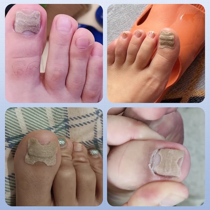 No-Glue Nail Correction Patch Toenail Sticker Nail Wrap Nail Repair Ultra-Thin Ingrown Nail Correction Sticker Daily Use