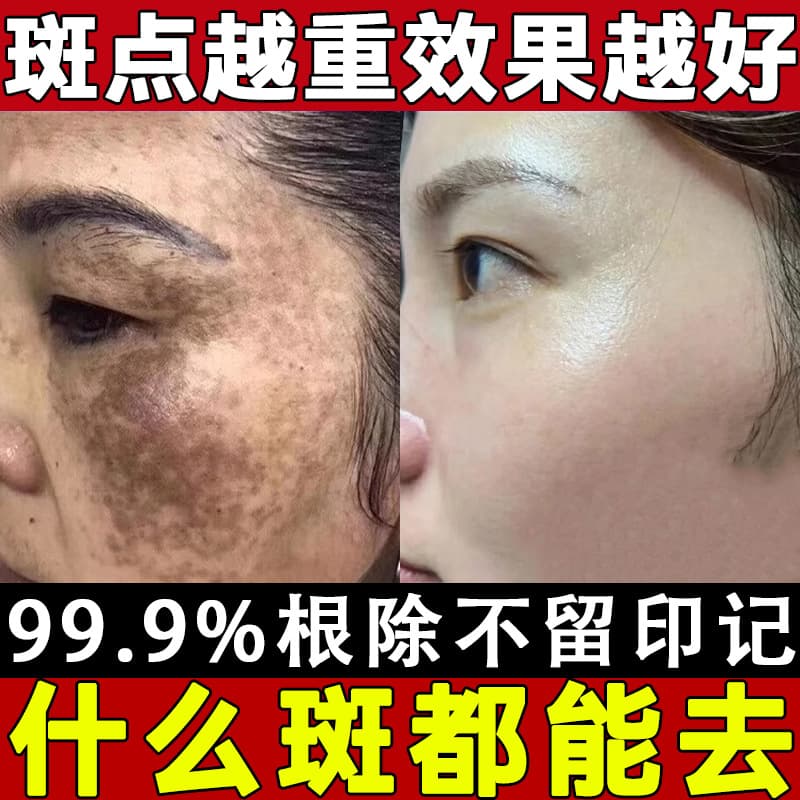 Beauty Salon Whitening Freckle Cream Strong Freckle Removal Cream Remove Melanin Remove Chloasma Freckle Cream Spot Blasting Cream Set