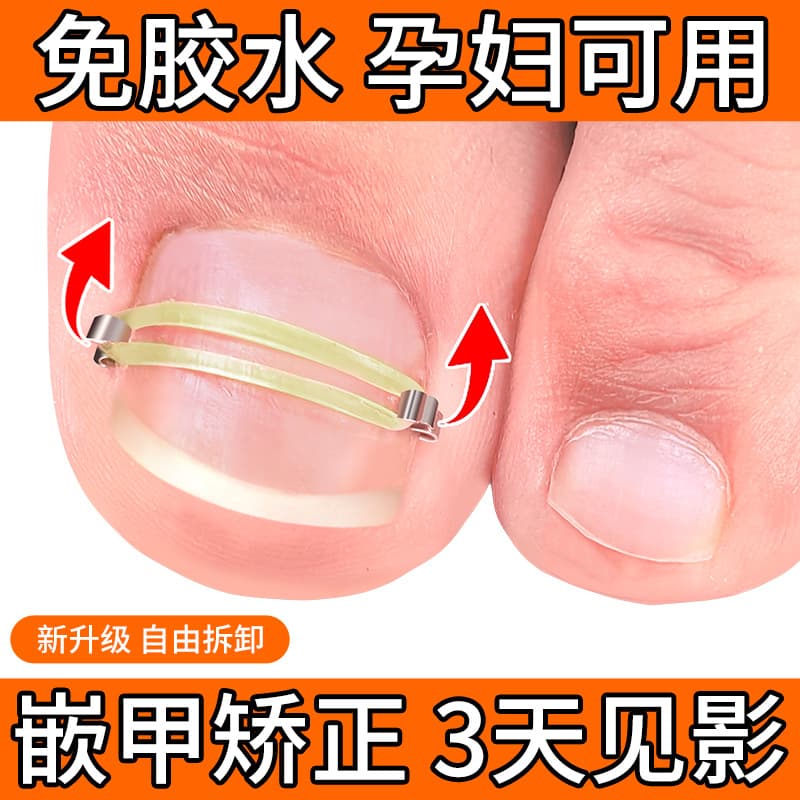 Ingrown Toenail Corrector Kit, Nail Correction Hook, Toenail Straightener for Curved Nails, Ingrown Toenail Treatment