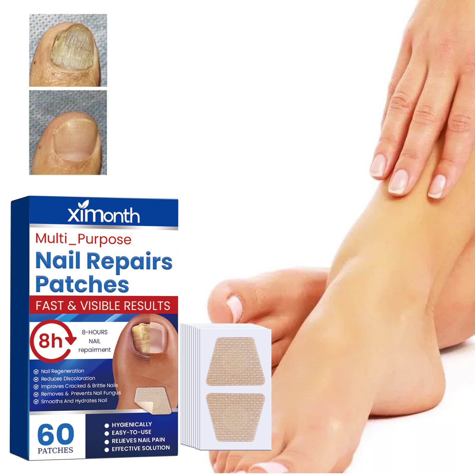 Ximonth Nail Care Patch for Soft, Thick, Ingrown, and Onychocryptosis Nail Issues