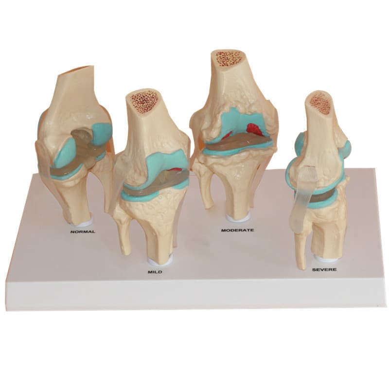 4-stage knee joint model with back card diseased knee joint model orthopedic teaching display teaching aid