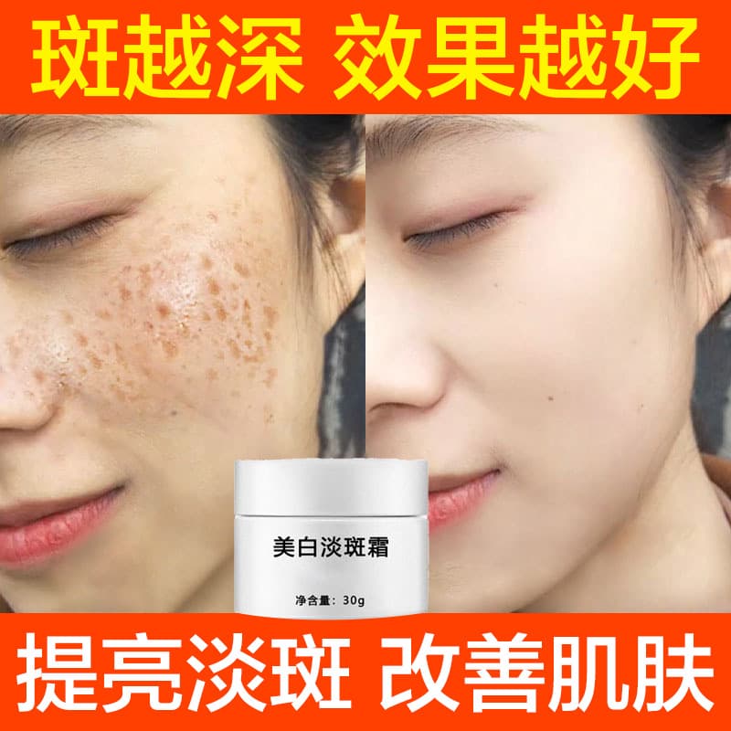 Whitening Freckle Removal Cream Removes Melanin Fades Spots Brightens Skin Tone Removes Dark Spots Melasma Freckles Sun Spots Special Certificate Spot Removal Cream