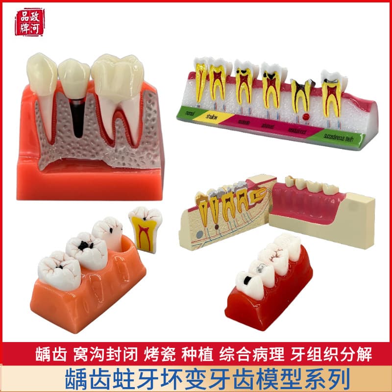 Dental Caries Progression Model - 4X Enlarged Tooth Decay Comparison, Cavity Development Evolution, Dental Caries Tooth Model