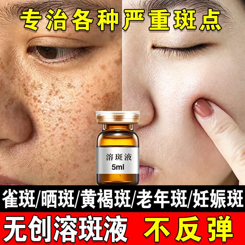 Non-Invasive Spot Dissolving Liquid Decomposes Melanin Improves Dullness and Yellowing Removes Freckles Sun Spots Melasma Dermal Spots Whitening Essence