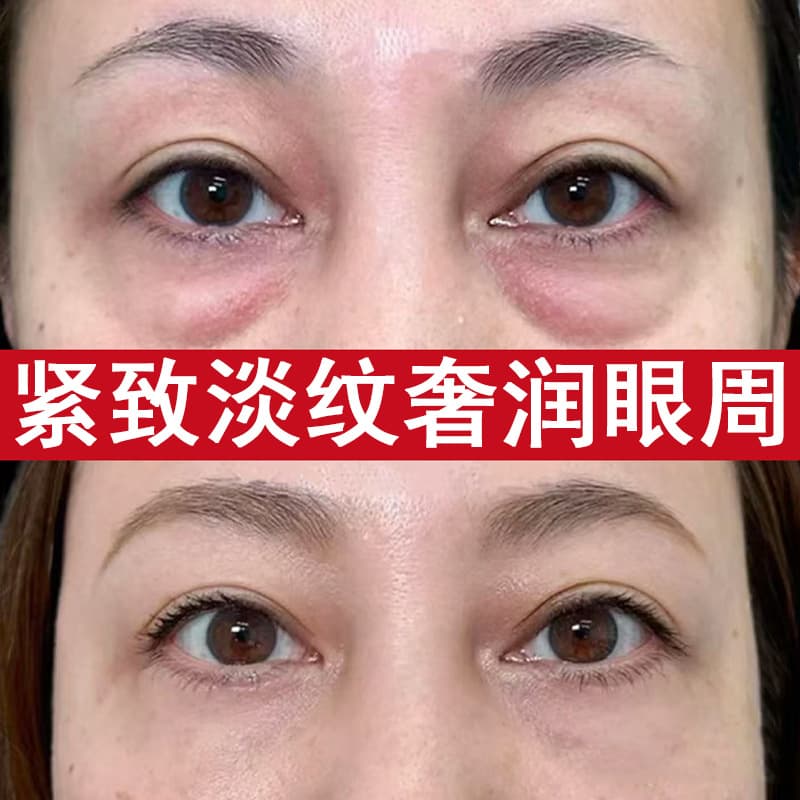 Caffeine Eye Cream for Dark Circles, Eye Bags, Milia, Ultrasonic Knife Anti-Wrinkle Cream, Firming and Moisturizing Eye Cream with Pro-Xylane and Peptides