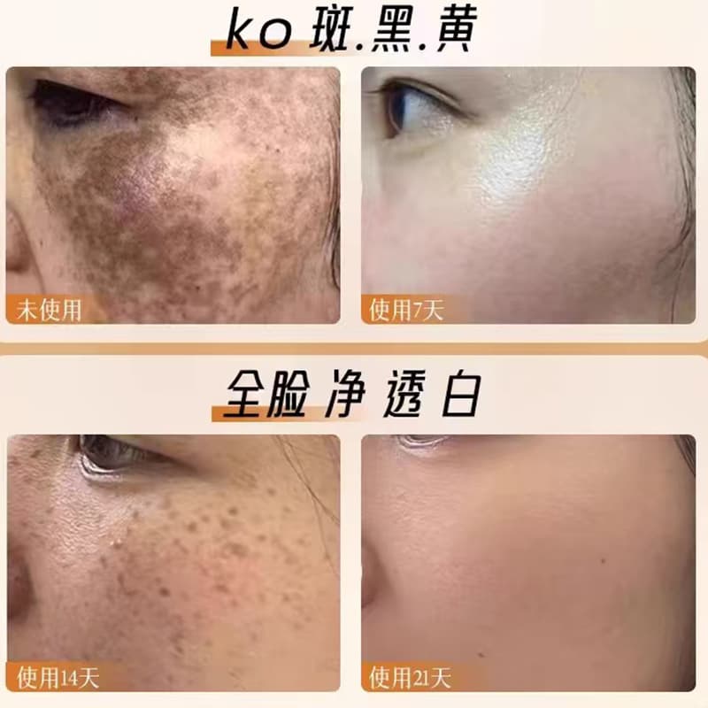 Beauty Salon Freckle Remover Serum, Pigment Decomposition, Fades Melasma and Dark Spots, Whitening Essence