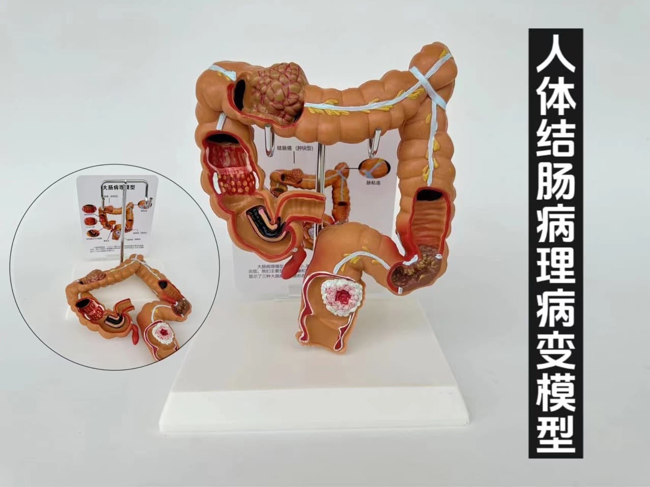 Colon Pathology Model Colon Model Colon Lesion Model Intestinal Disease Human Colon Lesion Model