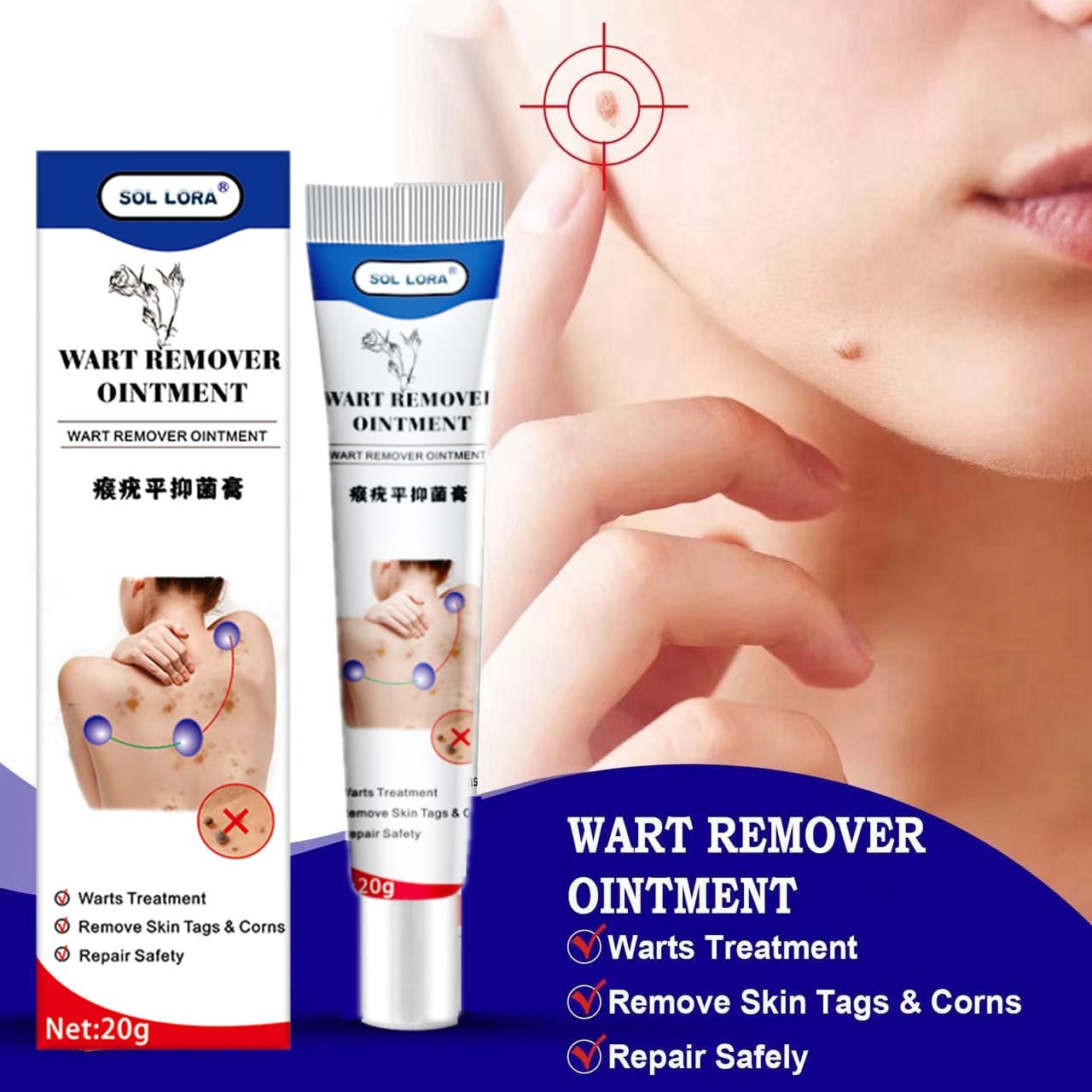 SOL LORA Cross-border Wart Removal Cream, Wart Ointment, Filiform Wart, Corn Ointment, Verruca Cream, Topical Skin Ointment