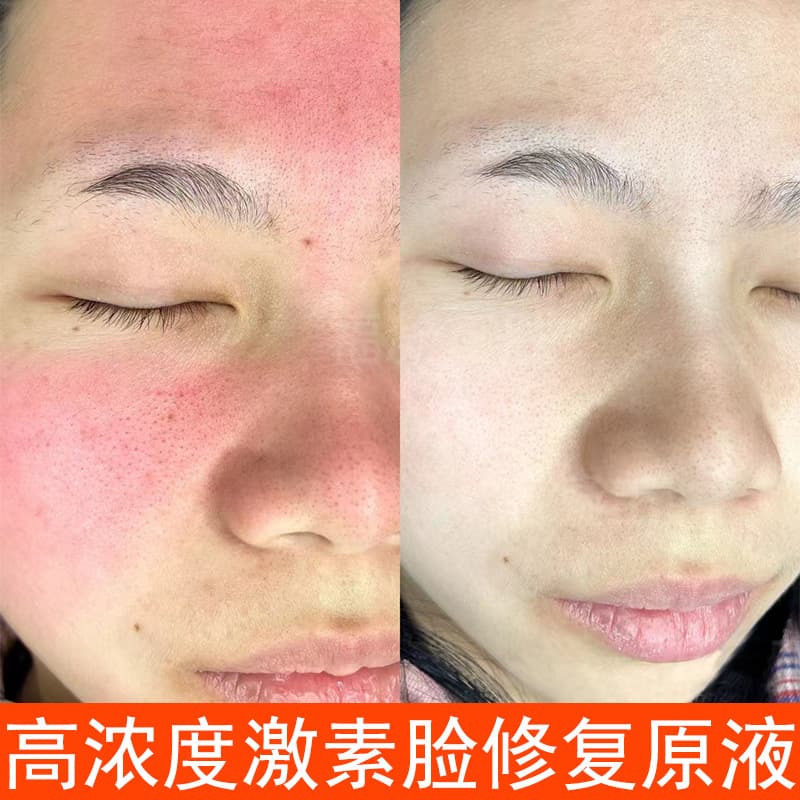 Hormonal Face Repair Serum for Redness Relief, Hydrating, Soothing, Sensitive Skin, Licorice and Centella Asiatica Repair Essence