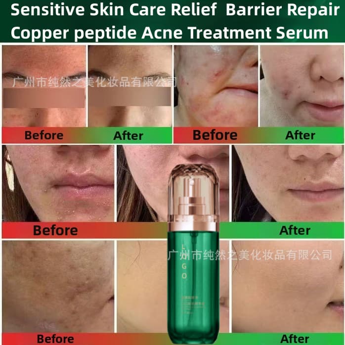 Sensitive Skin Repair Blue Copper Peptide Acne Treatment Serum Professional Skincare OEM